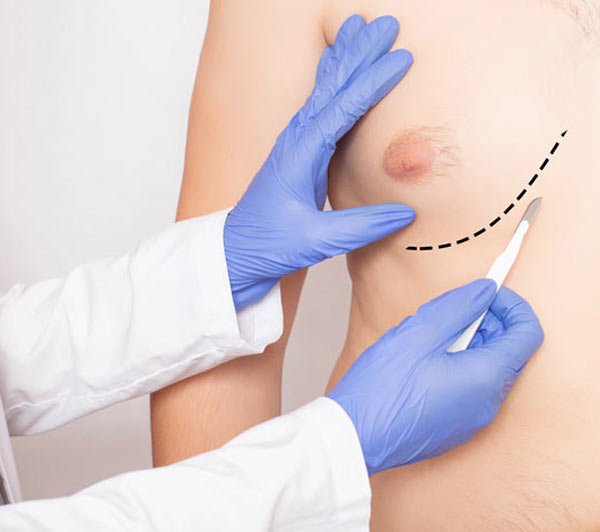 גניקומסטיה - הקטנת שדיים בגברים