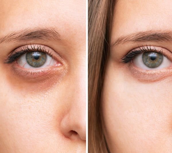 מילוי שקעי עיניים