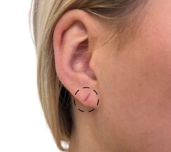 סגירת קרע בתנוך האוזן