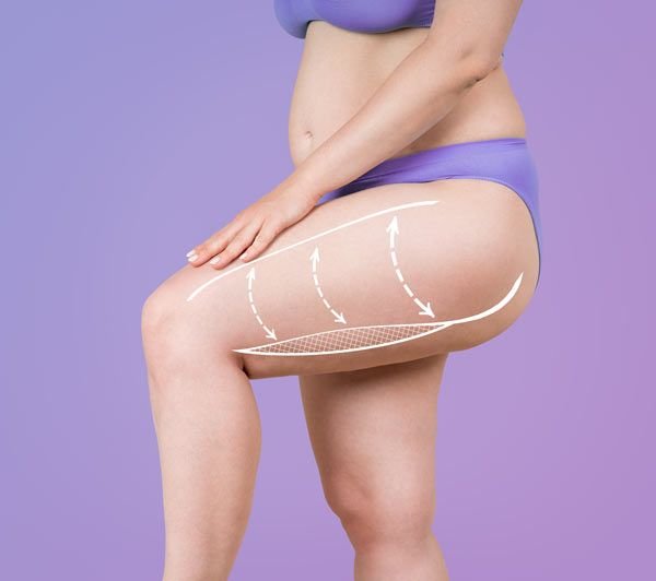 ניתוח מתיחת ירכיים