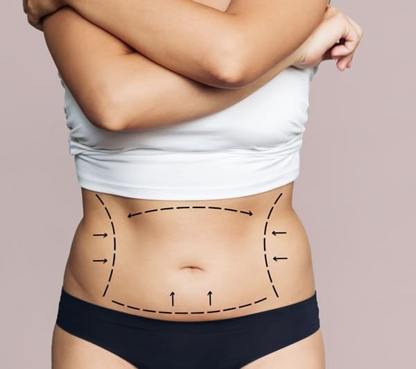 ניתוח שאיבת שומן