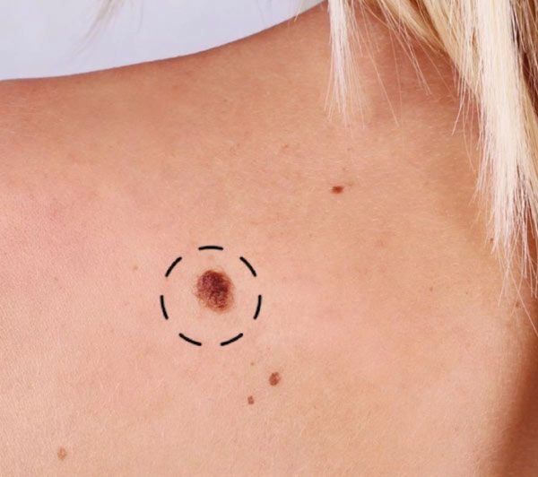 הסרת נגעי עור וסרחים