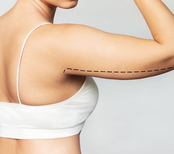 ניתוח מתיחת זרועות